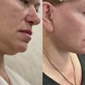 Отзыв о Эндоскопическая подтяжка лица: Большое спасибо Белому Игорю
