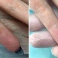 Жизнь без бородавок благодаря Verrutol!