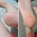 Отзыв о VERRUTOL: Действенное и эффективное средство